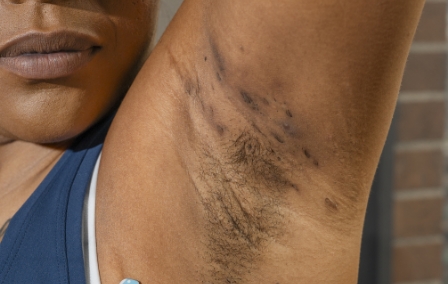 Image of HS on underarms