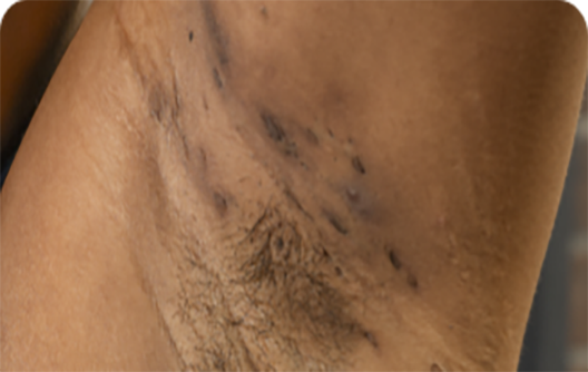 Image of scaring from boils and lesions